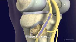 Peroneal and Tibial Intraneural Ganglion Cysts in the Knee Region Video 1 [upl. by Ripp]