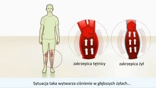 Zakrzepica  Przyczyny i leczenie [upl. by Eulalee]