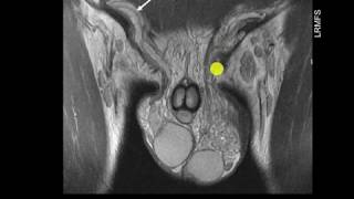 Varicocele testicular como diagnosticar [upl. by Anavas]