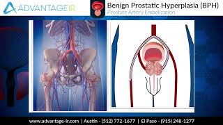 Prostate Artery Embolization PAE Explained [upl. by Attenna]